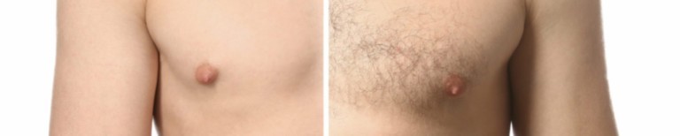 faq epilation laser bordeaux