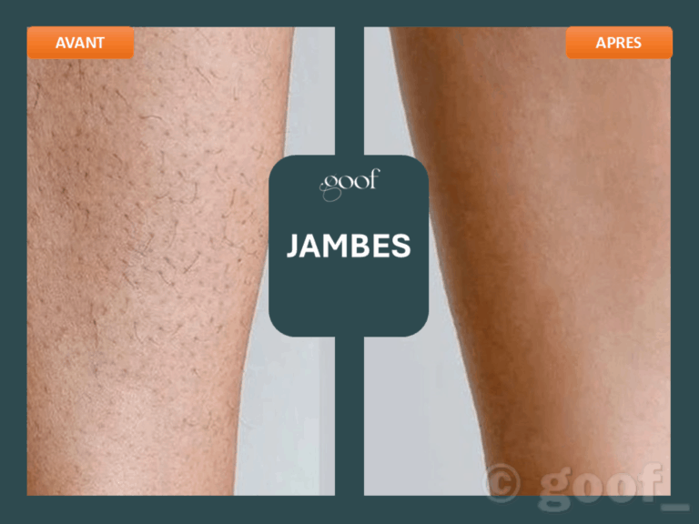epilation laser jambes bordeaux