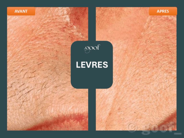 epilation laser levres bordeaux