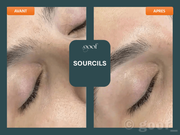 epilation laser sourcils bordeaux