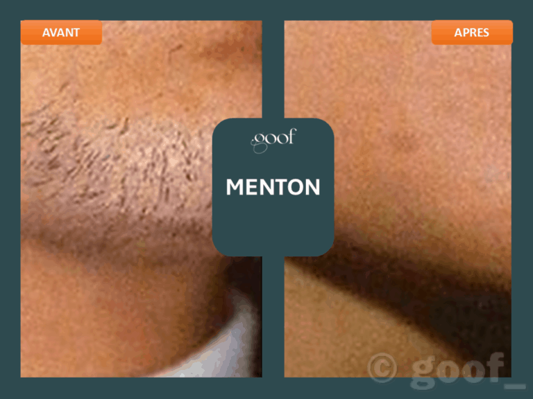 epilation laser menton bordeaux