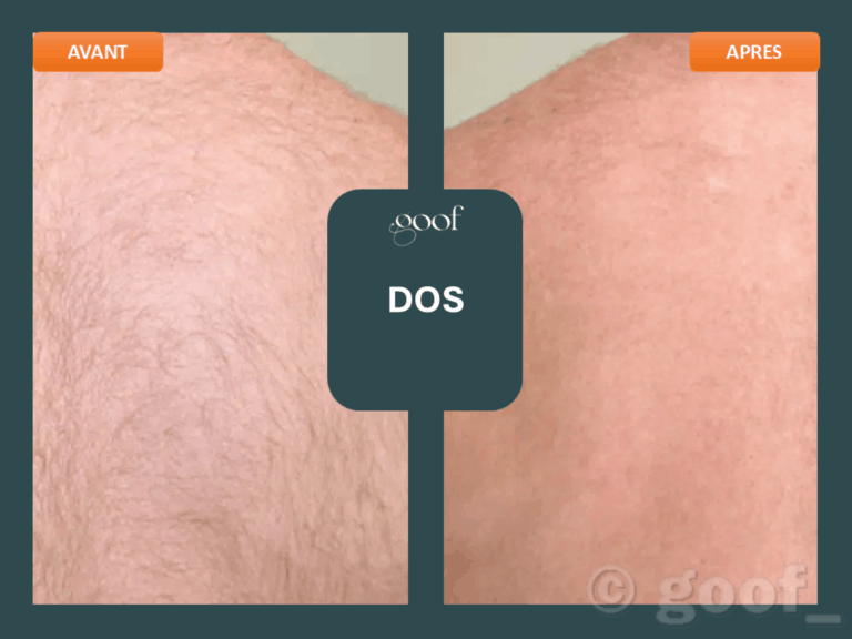 epilation laser dos bordeaux