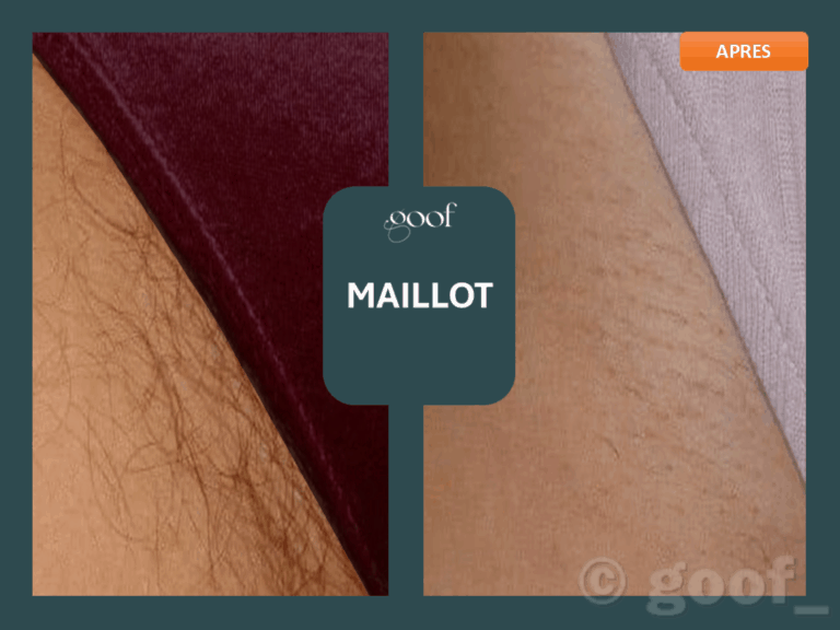 epilation laser maillot bordeaux