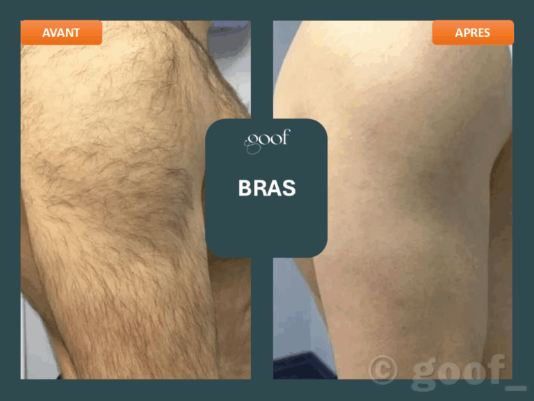 epilation laser bras bordeaux
