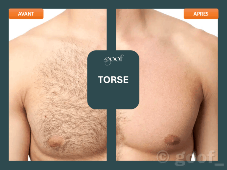 epilation laser torsebordeaux